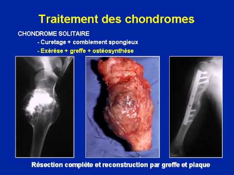 Osteochondrose krank Hals ÐÑ <Ñ ... Ð ° ниÐμ Ð¿Ñ € Ð Ð¾Ñ Ñ, ÐμÐ¾Ñ ... онÐÑ € оР· d & mgr; поР· Ð²Ð¾Ð½Ð¾Ñ ‡ ° никÐ