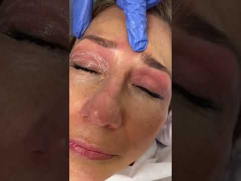 Blefaroplastia sin cirugía en Cali - Plasma Laser para elevar el párpado