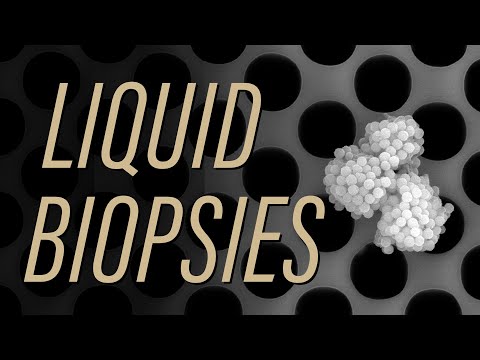 Liquid biopsies detect breast cancer recurrence