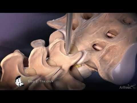Interlaminar Approach for Discectomy Procedures
