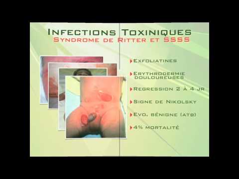 comment guerir staphylocoque doré