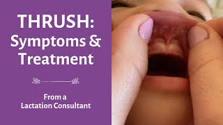 Thrush breastfeeding | thrush breastfed baby | diaper rash treatment | breast thrush