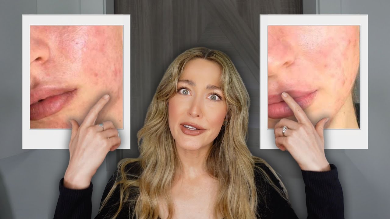 How I Healed My Acne Scars and Boosted Collagen Naturally