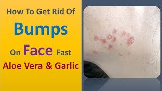 how to get rid of bumps on face fast - Aloe Vera & Garlic