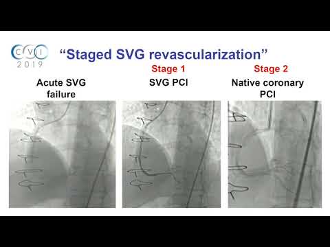 CVI 2019_Saturday, 7/20_ Innovations in PCI Part 1_Kendrick Shunk, MD, PhD