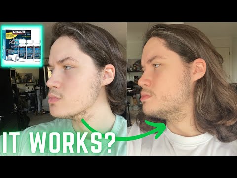 Minoxidil 9 Months Update (FINALLY PROGRESS!)