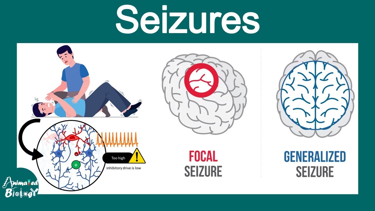 Seizures | Etiology, Pathophysiology, Clinical Features, Treatment, Complications/Status Epilepticus