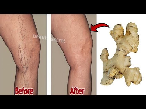 , title : 'Say goodbye to varicose veins and joint pain with only 2 natural ingredients, 100%effective'
