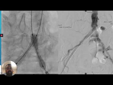 Hybrid Approach to Simultaneous Aortoiliac and CFA Disease_Madassery_Peripheral