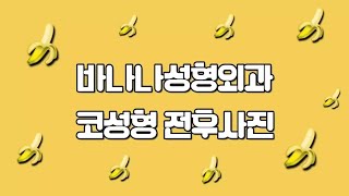 바나나 성형외과 코성형 전후사진