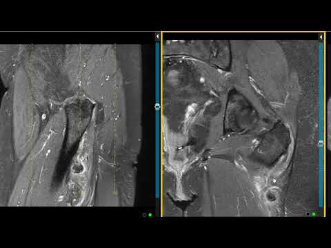 Gluteus muscle tear and anatomy