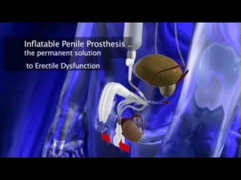 Prostatitis oder Verstopfung Prostata-Behandlung Steine