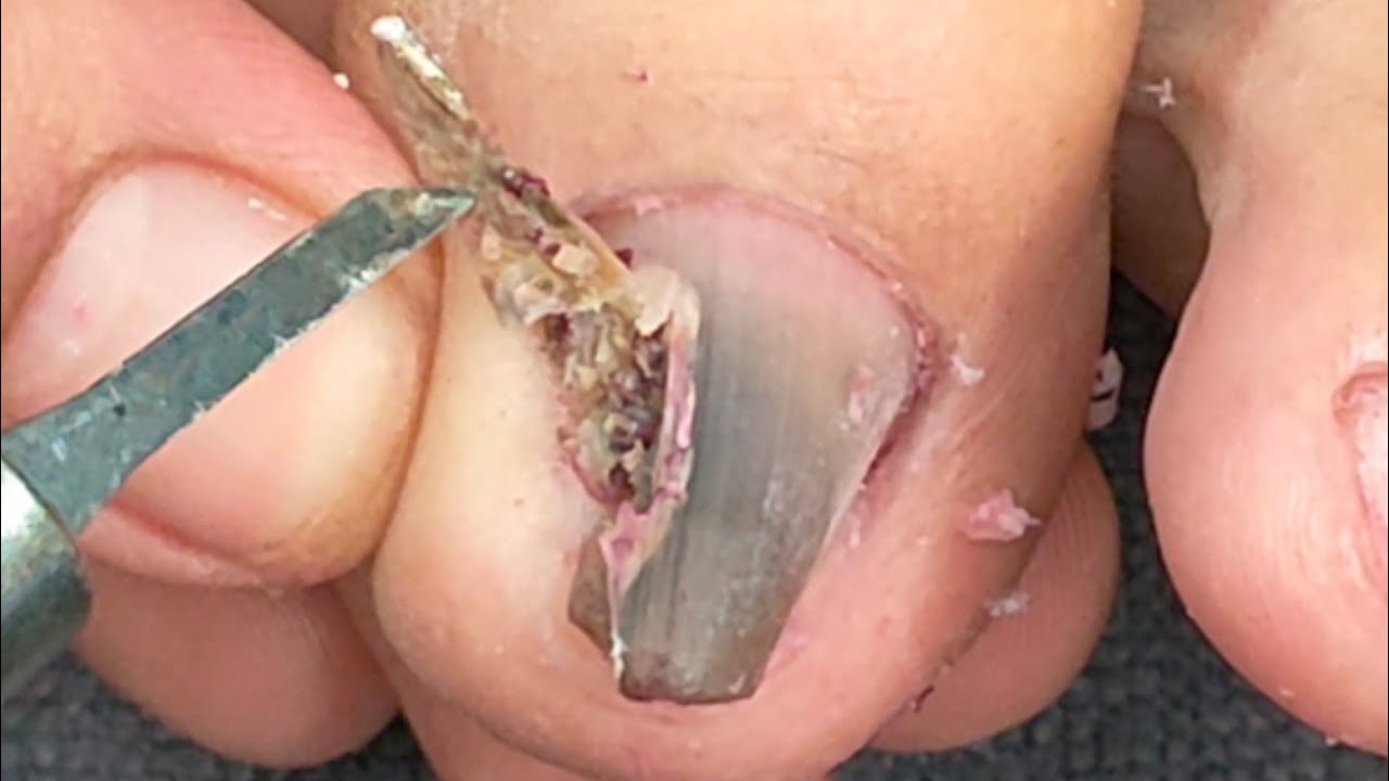 Putar video PATAY NA KUKO DAHIL SA FUNGUS sekarang PATAY NA KUKO DAHIL SA FUNGUS