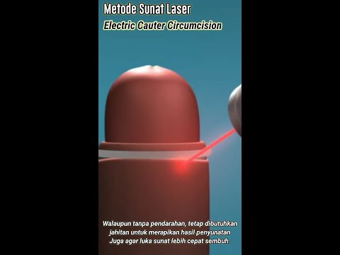 Animasi Sunat laser, Sakit tak berdarah metode Electric Cauter Circumcision