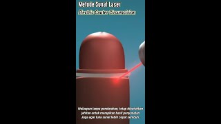 Download lagu Animasi Sunat laser, Sakit tak berdarah metode Electric Cauter Circumcision mp3 Download lagu Animasi Sunat laser, Sakit tak berdarah metode Electric Cauter Circumcision mp3