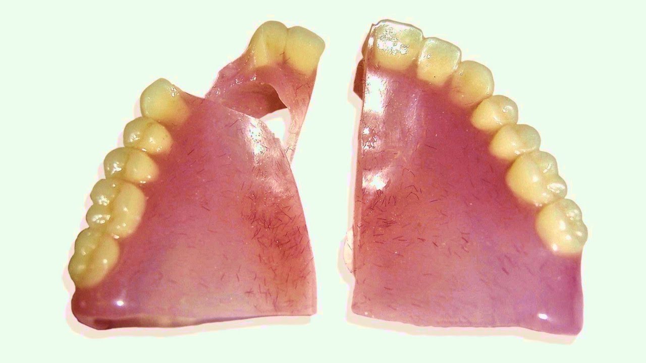 How to Repair a Broken Denture in 25 Minutes