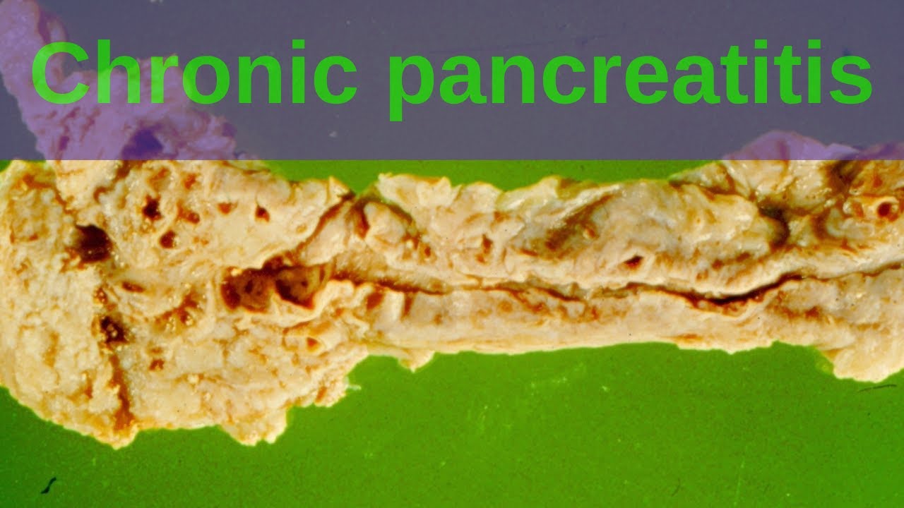 Chronic Pancreatitis - Pathology mini tutorial