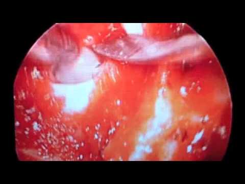 Endoscopic Pituitary Surgery - Rathke Left Cyst in the Sella