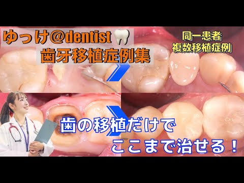 生命歯学科 【歯牙移植症例集】矯正で綺麗な歯並びを手に入れたのに複数本の抜歯宣告に涙。歯の移植治療だけでここまで治せる 同一患者さんによる複数本移植🦷歯根分割移植と親知らず移植を公開‼️
