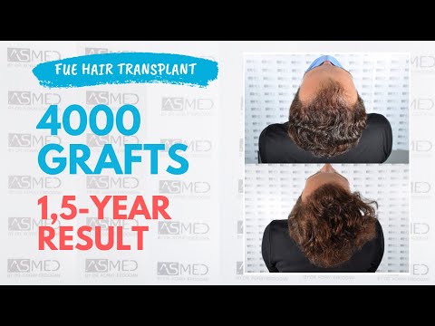Manual FUE Hair Transplant Before & After 4000 Grafts 1.5-Year Result - ASMED - Dr. Koray Erdogan