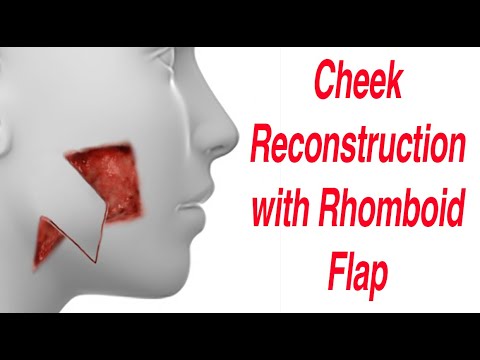 Reconstruction surgery After Oral Cancer Using Rhomboid Flap