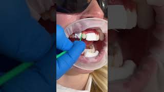 Download lagu Composite Bonding Makeover ✨ 8 teeth treated 🤍 mp3