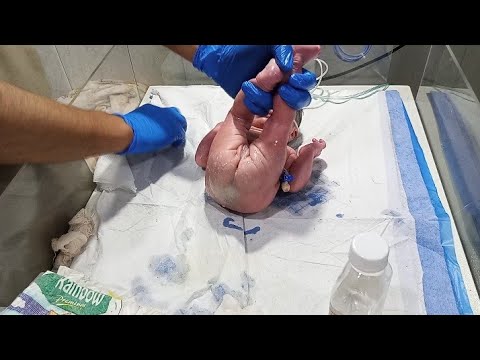💔 Premature Baby in NICU | Daily Resuscitation & Cry | Tiny Fighter’s Journey to Survival 🍼👶