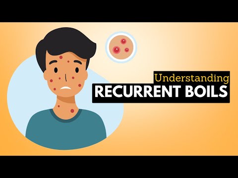 Recurrent Boils