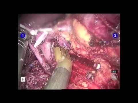 Single Incision Robotic-Assisted Donor Nephrectomy