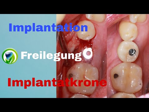 Zahnimplantation, Freilegung, Abformung, Implantatkrone - Ablauf | Zeitraum | Dauer | Termine