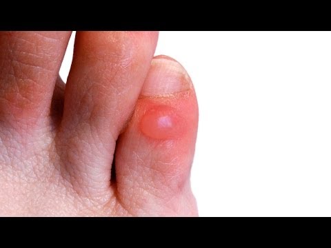 How to Prevent & Treat Foot Blisters | Foot Care
