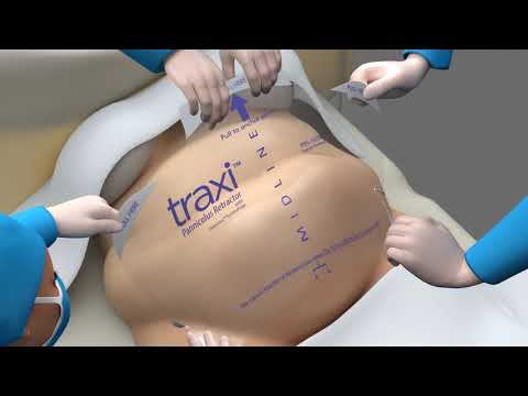 traxi™ Panniculus Retractor Step by Step Animation (3 Minute Version)