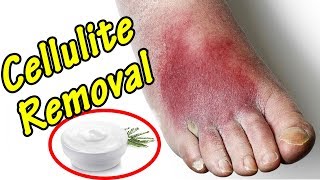 How to Get Rid of Cellulitis - 5 Home Remedies.