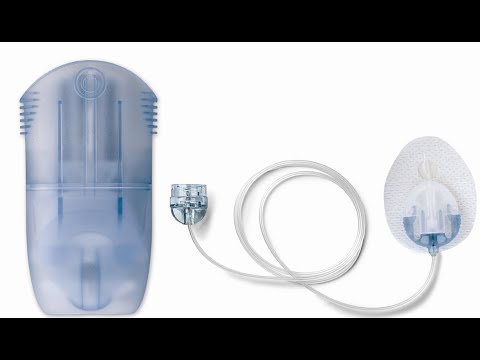 ΕΥΚΟΛΙΑ ΓΙΑ ΔΡΑΣΤΗΡΙΑ ΚΑΙ ΛΕΠΤΑ ΑΤΟΜΑ
MiniMed™ Mio™ 30 ΣΕΤ ΕΓΧΥΣΗΣ
Αυτό το σετ έγχυσης όλα-σε-ένα προσφέρει ευκολία στα ενεργά και δραστήρια άτομα. Η γωνία 30° το καθιστά κατάλληλο για ενήλικες και παιδιά που έχουν αθλητικό ή λεπτό σωματότυπο. Είναι επίσης κατάλληλο για έγκυες γυναίκες από το τέλος του δεύτερου τριμήνου και μετά, όταν ο κοιλιακός ιστός αρχίζει να σφίγγει.
Δείτε το video και μάθετε πως να εισαγάγετε το σετ έγχυσης MiniMed™ Mio™ 30