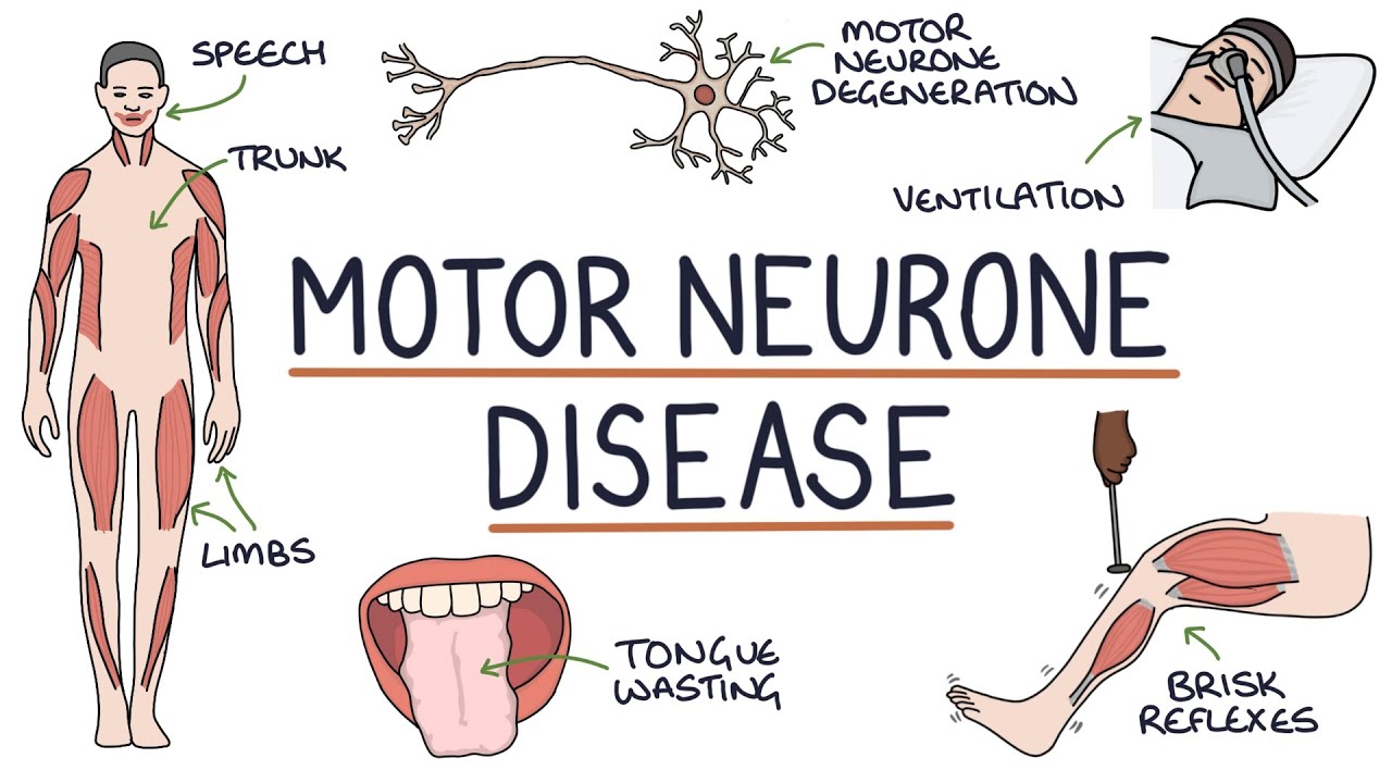 Understanding Motor Neurone Disease (Amyotrophic Lateral Sclerosis)