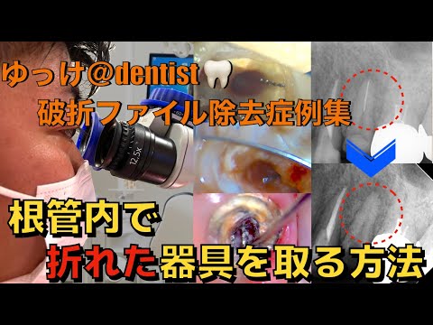 生命歯学科 【破折ファイル除去治療症例集】マイクロスコープを用いた破折ファイルの除去の方法を詳しく解説します！