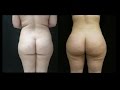 Brazilian Butt Lift Markings And Explanation