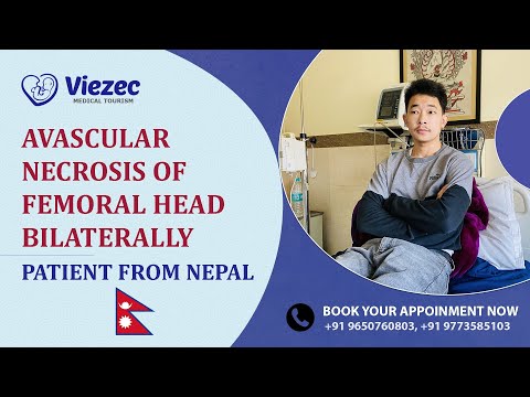 Stem Cell Therapy for Avascular Necrosis of Femoral Head Bilaterally