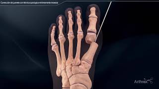 Corrección de juanete con técnica quirúrgica mínimamente invasiva