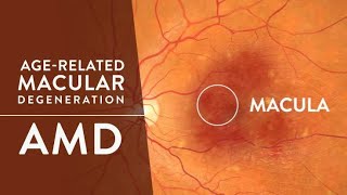 Age Related Macular Degeneration | Anti - VEGF ||  ARMD- Patient Education & Explanation