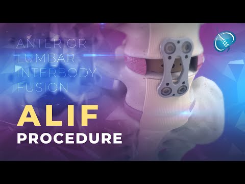 What is Anterior Lumbar Interbody Fusion? | ALIF