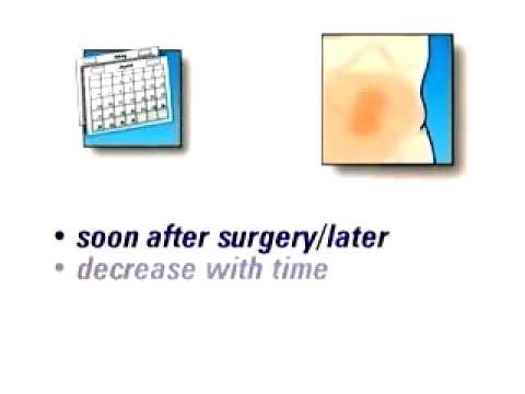 PreOp® Patient Education Hernia Hiatal Laparoscopic Recovery