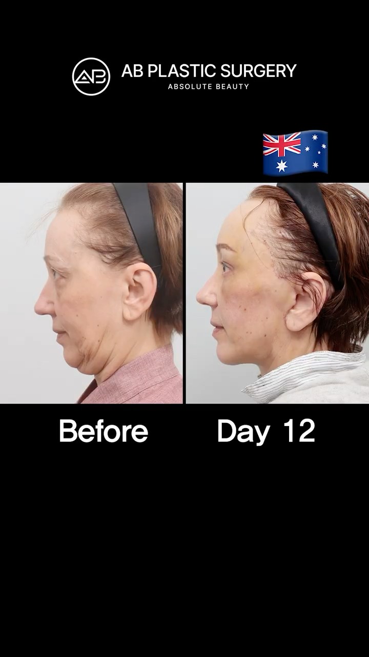Age 60, But Looks 40 After Facelift
