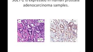 Original Research Proposal: Investigating the Role of SGLT2 in Altered Metabolism of Prostate Cancer