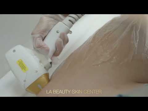 Laser Hair Removal w/ Stephanie Acevedo