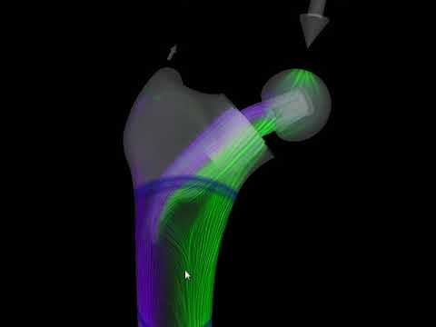 Stress Tensor Field Visualization for Implant Planning in Orthopedics