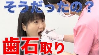 えっ、そうだったの！歯石とりの誤解