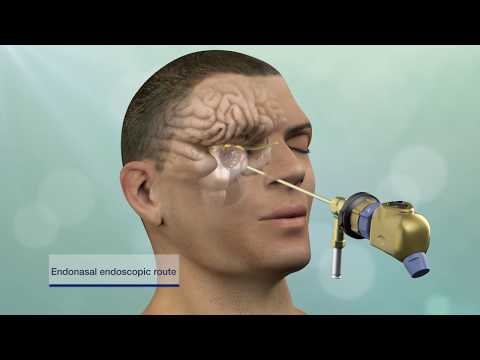 Updated Video Available: Keyhole Brain Tumor and Skull Base Surgery