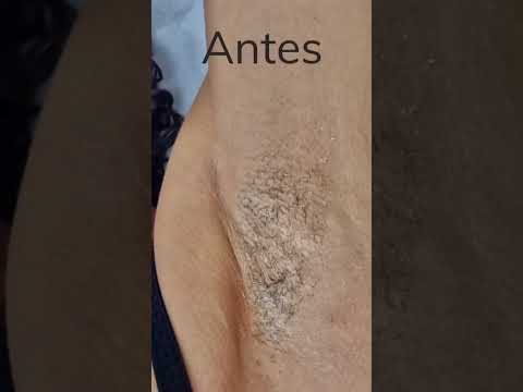 Depilação a Laser na #draveronicamessias 📍 #novaiguaçu #depilação