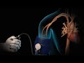 High Blood Pressure | Hypertension | Nucleus Health High Blood Pressure | Hypertension | Nucleus Health